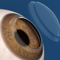 vizonic-formula-oculare-italia.webp